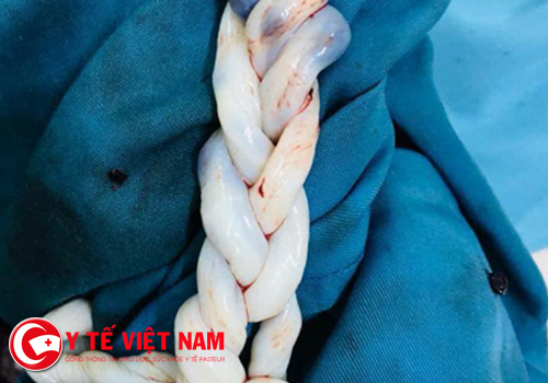 Chuyện lạ Việt Nam: Hai bé sinh đôi khỏe mạnh dù dây rốn xoắn như tóc kết