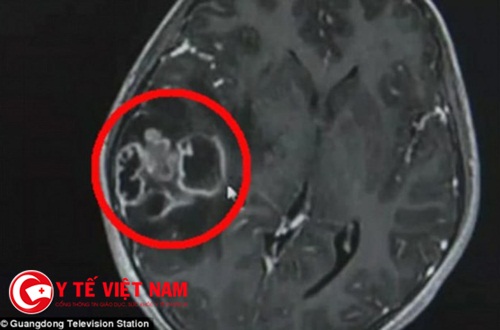 Bé gái 10 tuổi nhập viện phẫu thuật não vì nhiễm trùng sau nặn mụn đầu đen