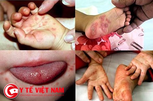 Sở y tế Hà Nội cảnh báo dịch tay chân miệng đang tăng theo cấp số nhân