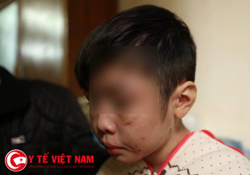 Bé trai 10 tuổi bị bố ruột bạo hành dã man tại Hà Nội