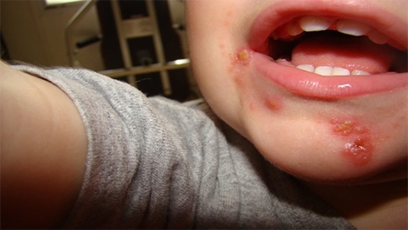 Cha mẹ cần thận trọng khi trẻ mắc bệnh chốc lở ngoài da