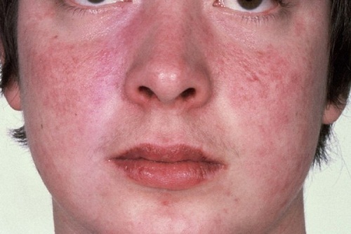 Nguyên nhân nào gây ra lupus ban đỏ hệ thống?
