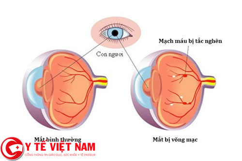 Biến chứng liên quan đến các bệnh về mắt