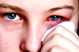 Biến chứng đau mắt đỏ nỗi sợ hại đối với nhiều người đã từng mắc bệnh