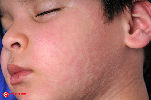 Bệnh sỏi do virus  nằm ở mũi họng gây ra