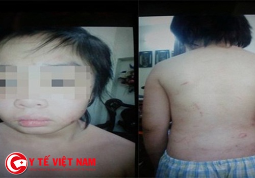 vHà Nội: Bố bạo hành khiến con trai 10 tuổi tổn thương 70% xương sườn