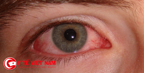 Chữa đau mắt đỏ phải trị dứt điểm