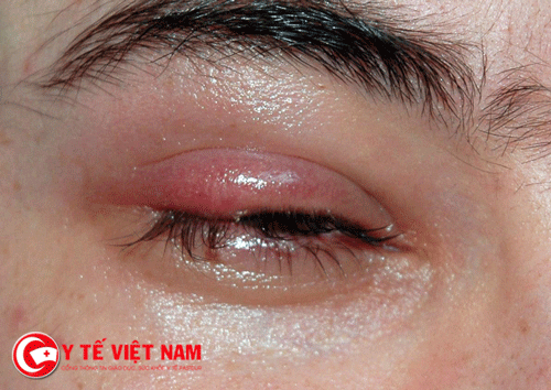 Cách chữa đau mắt đỏ hiệu quả