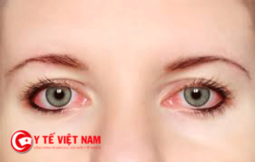 Đau mắt đỏ bao lâu thì khỏi?