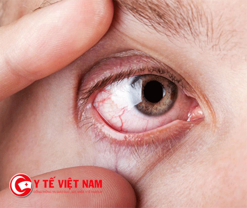 Đau mắt đỏ có khả năng lây qua đường hô hấp không?
