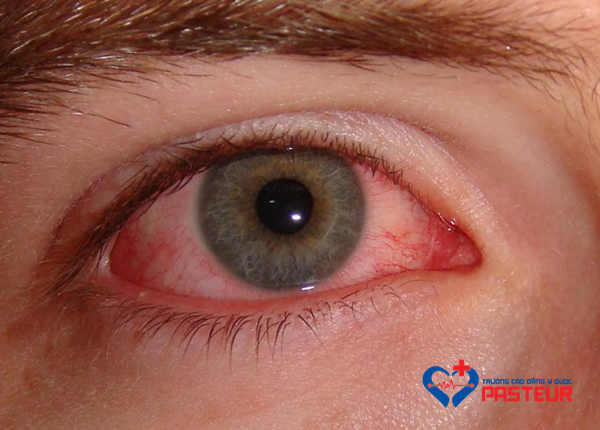 Triệu chứng đau mắt đỏ do virus
