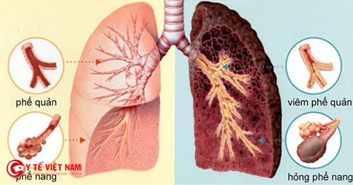 Bệnh ung thư phổi gây tử vong cao