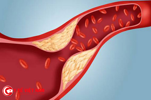 Cholesterol trong máu cao ảnh hưởng lớn đến sức khỏe con người