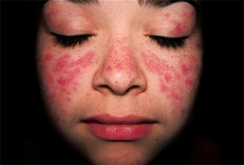 Hậu quả khôn lường mà bệnh Lupus ban đỏ hệ thống gây ra cho người bệnh