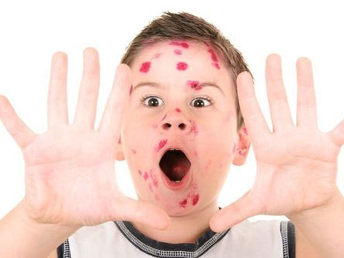 Các triệu chứng bệnh thủy đậu ở trẻ em rất dễ  nhận biết