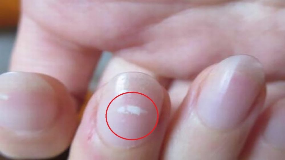 Đốm trắng xuất hiện trên móng tay của bạn tiết lộ bệnh nguy hiểm gì?