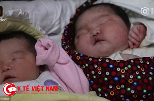 Sản phụ sinh mổ thành công trẻ sơ sinh nặng nhất Trung Quốc