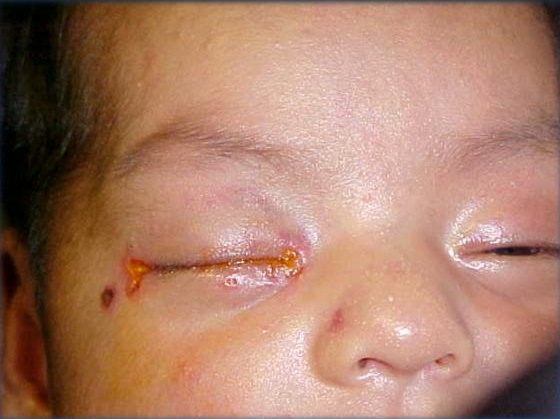 Bệnh lậu truyền cho trẻ sơ sinh có thể gây mù mắt