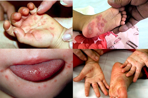 Những triệu chứng bệnh tay chân miệng ở trẻ em rất rõ rệt