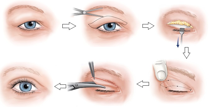 Kỹ thuật cắt mí mắt an toàn để xử lí sụp mí, mỡ mí mắt nhiều