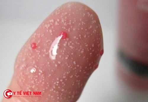 Sử dụng sữa rửa mặt dạng hạt có thể gây bào mòn da