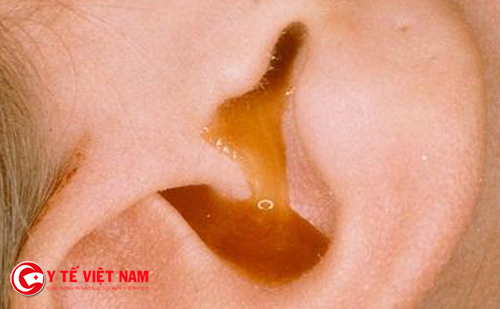 Viêm tai giữa ở trẻ em thường bị chảy mủ