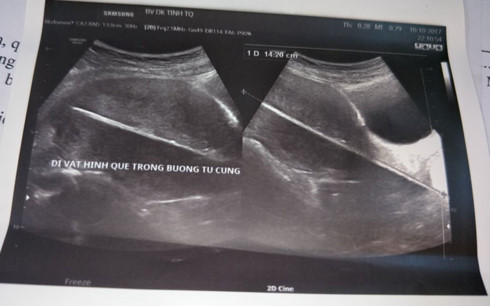 Bác sĩ lấy dị vật trong buồng tử cung của thai phụ thành công