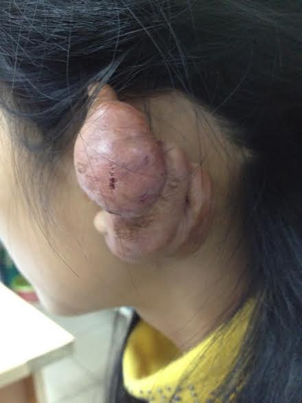 Hình ảnh của bệnh nhân sau bấm lỗ tai