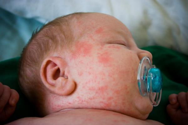 Trẻ bị sốt li bì hoặc đang sốt cao bỗng dưng hết sốt sẽ rất nguy hiểm
