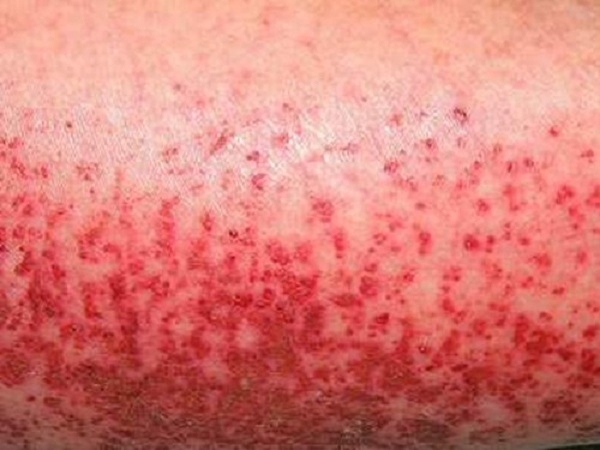 Xuất huyết dưới da là dấu hiệu đặc trưng của bệnh sốt xuất huyết