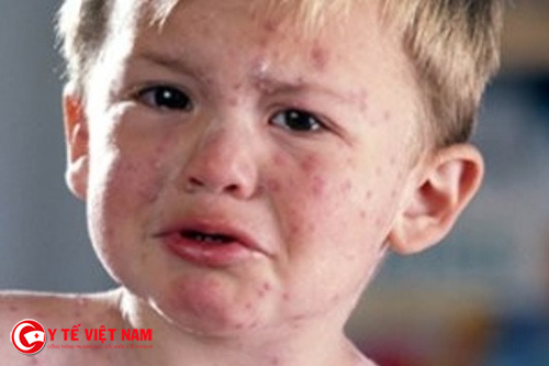 Trẻ em mắc bệnh sởi từ 10-14 tuổi