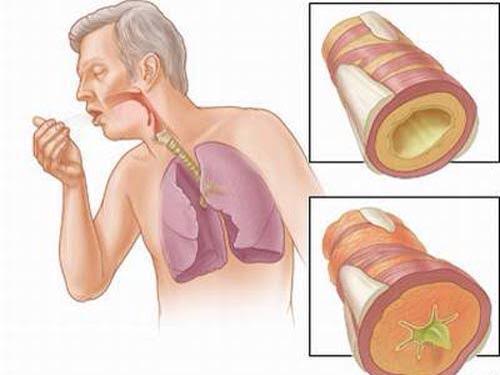 Bệnh nhân viêm phế quản thường ho nhiều kèm theo khó thở