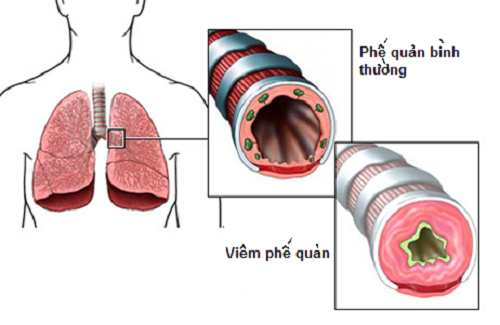 Viêm phế quản có thể gây nhiều biến chứng nguy hiểm như viêm phổi, viêm tiểu phế quản...