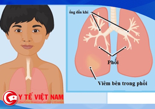 Bác sĩ Nhi giúp phụ huynh nhận biết những dấu hiệu điển hình của bệnh viêm phổi