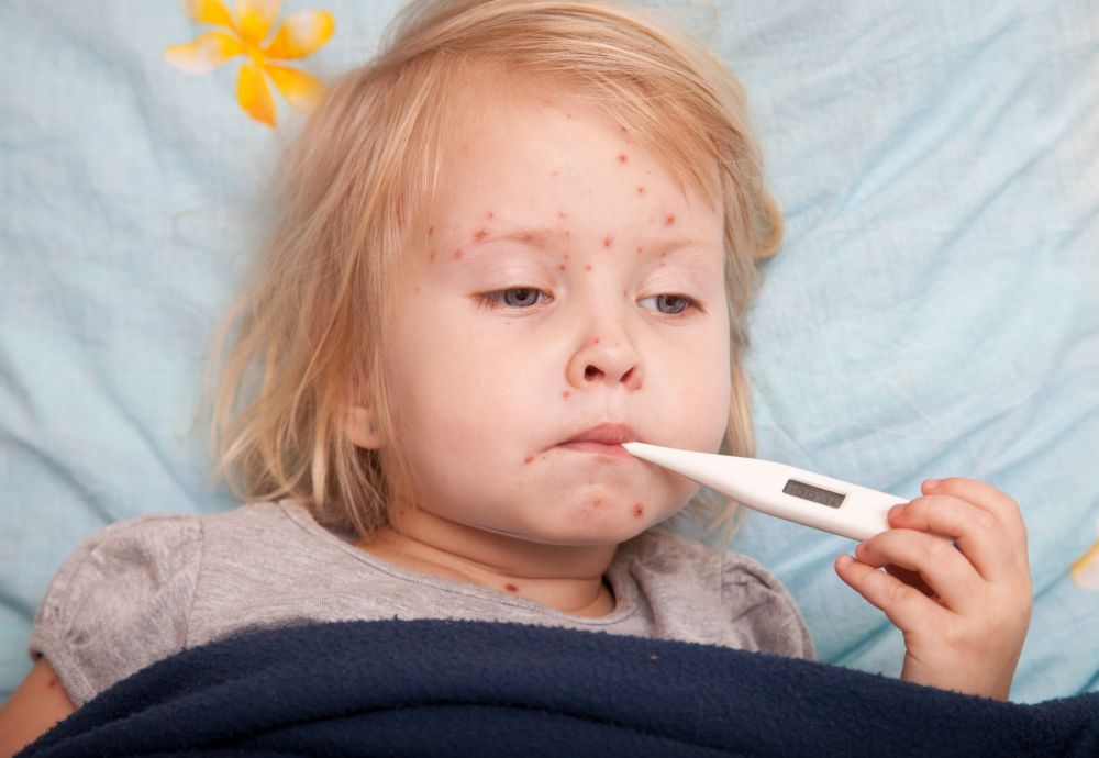 Bác sĩ chuyên khoa hướng dẫn cách phân biệt bệnh sởi và sốt phát ban ở trẻ em?