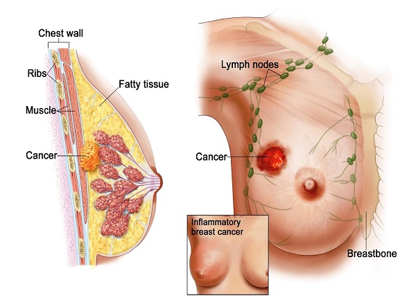 Không nên bỏ qua những biểu hiện cảnh báo của ung thư vú ở phụ nữ