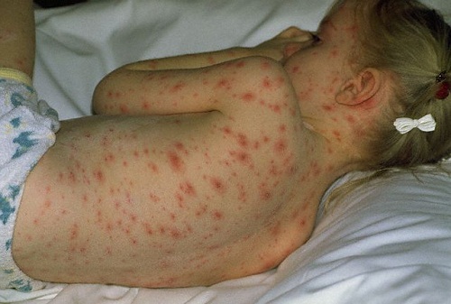 5 lầm tưởng “ chết người” về bệnh sốt xuất huyết ai cũng mắc