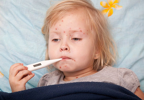 Bệnh thủy đậu ở trẻ em có biến chứng nguy hiểm không