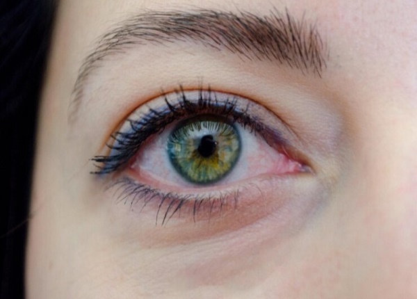 Tại sao đau mắt đỏ mắt chỉ đỏ một bên? Cách nào để điều trị ?