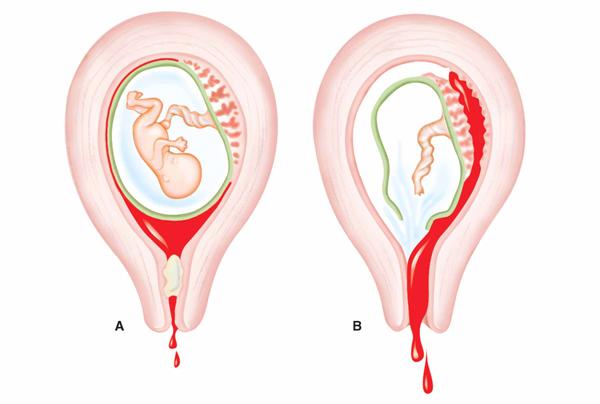 Vỡ tử cung: Tai biến sản khoa gây nguy hiểm đến tính mạng của mẹ và thai nhi