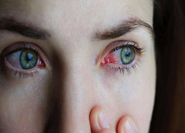 Khi nào nên sử dụng kháng sinh để điều trị viêm mắt đỏ?