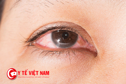 Bệnh đau mắt đỏ có thể lây qua những đường nào?