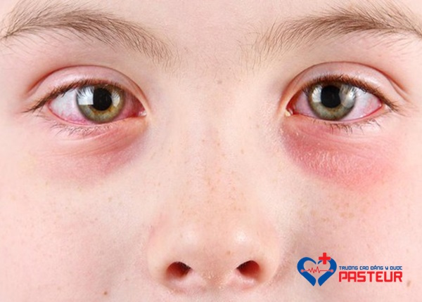 Cách nhận biết đau mắt đỏ chính xác nhất