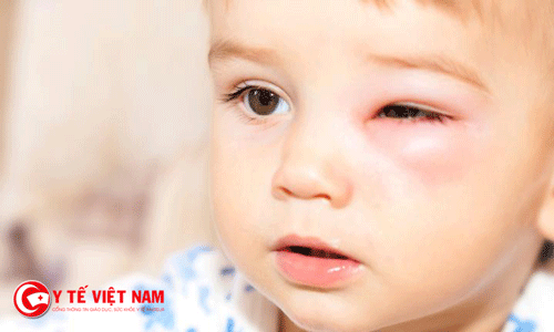 Đau mắt đỏ ở trẻ: nỗi lo thường trực của cha mẹ khi giao mùa