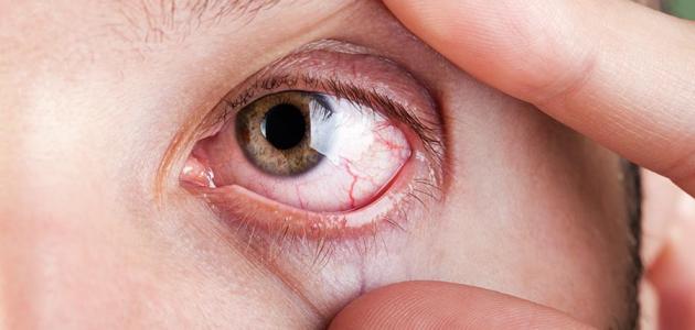 7 triệu chứng cảnh báo bệnh đau mắt hột không thể bỏ qua