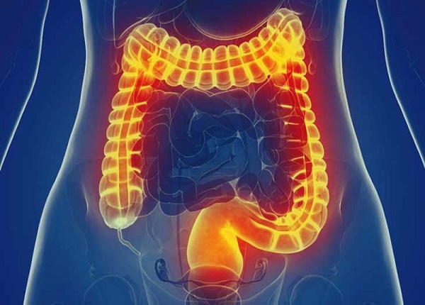 Hội chứng ruột kích thích – một rối loạn tiêu hóa thường gặp