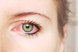 Chữa bệnh đau mắt đỏ kịp thời bảo vệ đôi mắt khỏi mù lòa