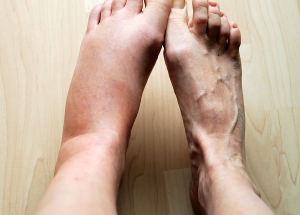 Các loại thuốc gây phù chân và cách xử lý ra sao?
