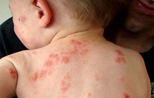 6 căn bệnh ngoài da thường gặp nhất ở trẻ nhỏ ngày nắng nóng